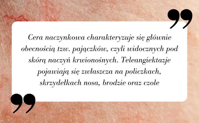 Cera naczynkowa charakteryzuje się głównie obecnością tzw. pajączków, czyli widocznych pod skórą naczyń krwionośnych. Teleangiektazje pojawiają się zwłaszcza na policzkach, skrzydełkach nosa, brodzie oraz czole