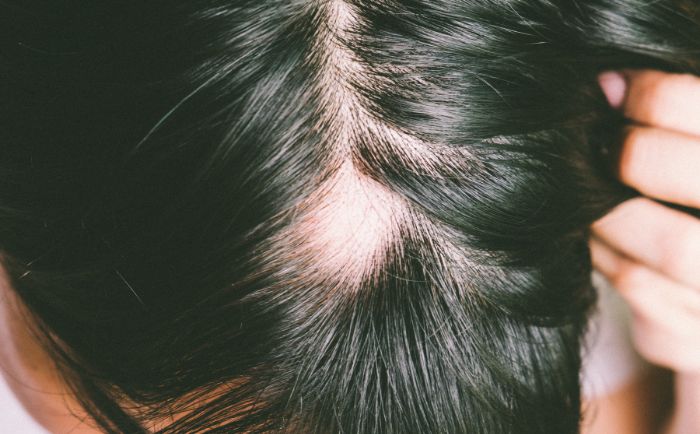 najczęstsze problemy pacjenta trychologicznego - sucha skóra głowy