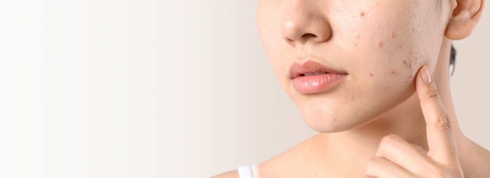 Cera tłusta trądzikowa - jak o nią dbać?