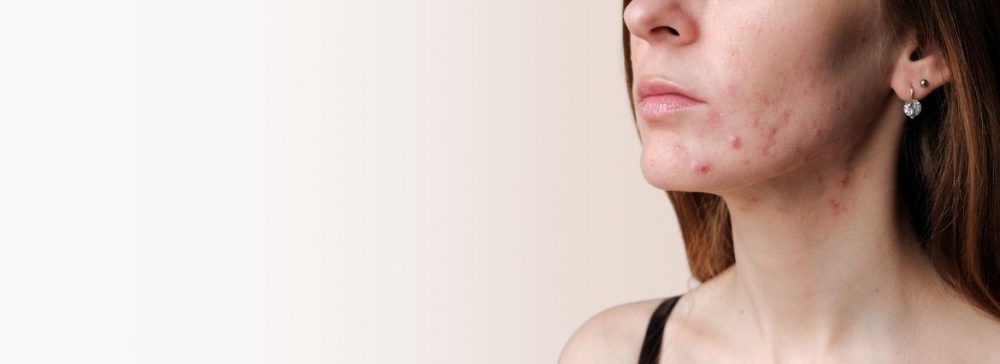 Pielęgnacja cery tłustej z niedoskonałościami
